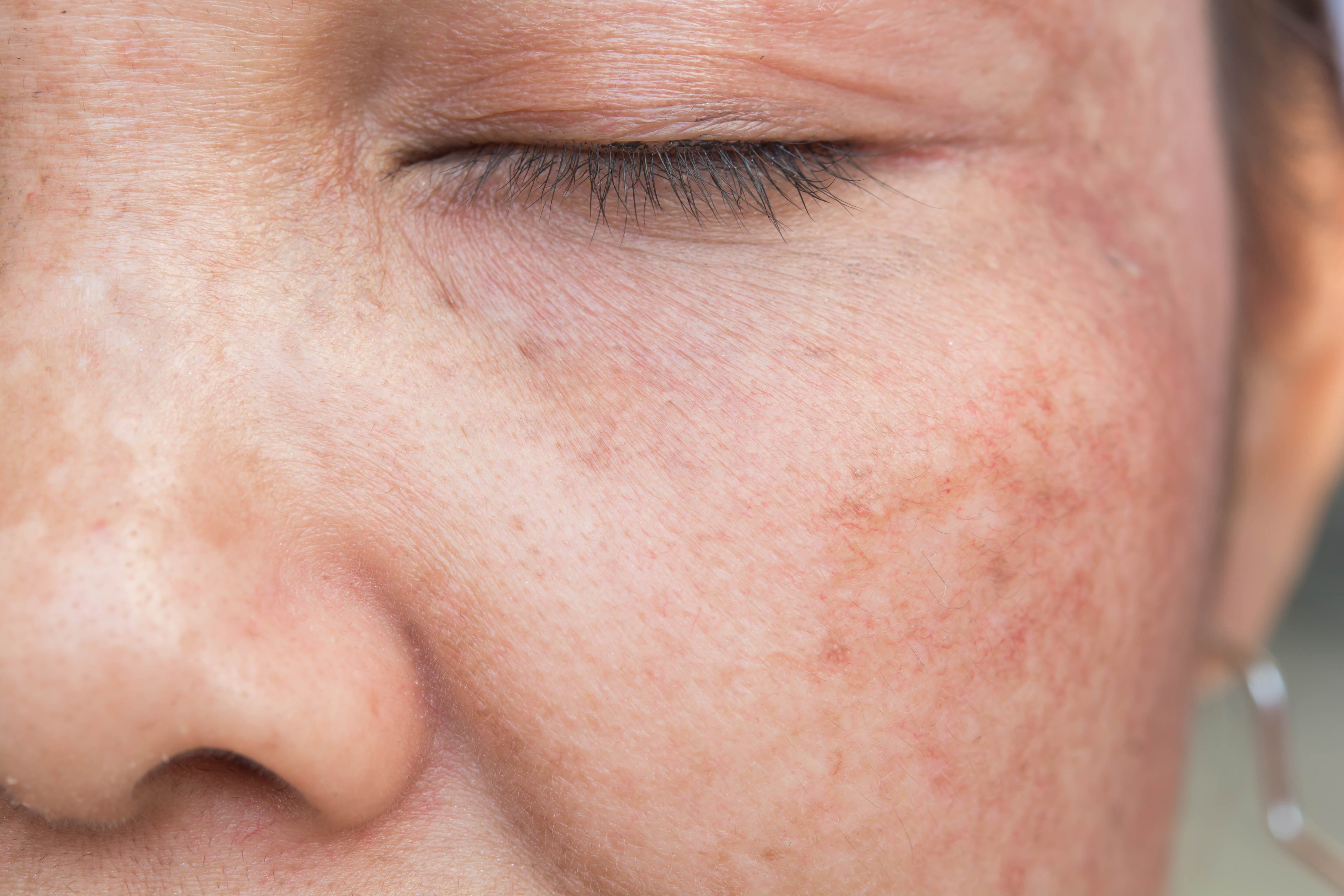 Melasma: sintomas, causas, tipos e tratamentos